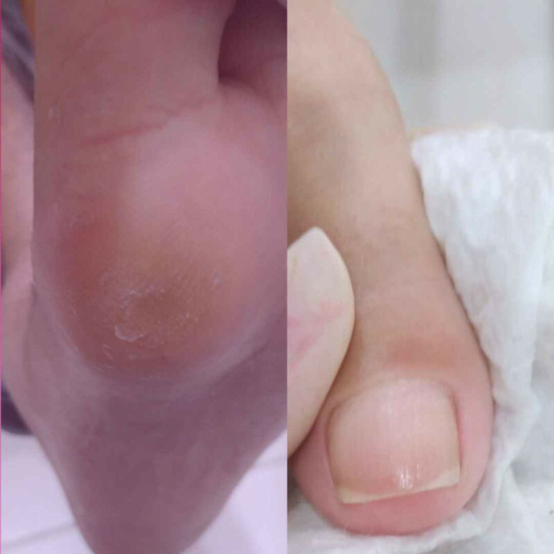 Corte Correto das Unhas, Calos e Calosidades Corte Correto das Unhas, Calos e Calosidades