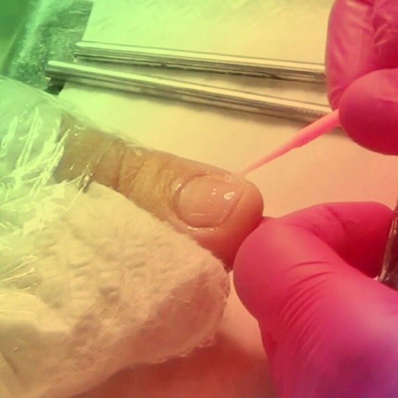 Peelings e Cauterizações na Podologia Peelings e Cauterizações na Podologia