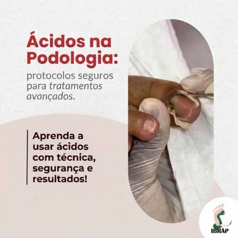 IBRAP - Ácidos na Podologia (Verrugas, Onicofose e Onicocriptose) IBRAP - Ácidos na Podologia (Verrugas, Onicofose e Onicocriptose)