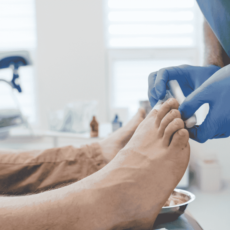 Onicocriptose e Granuloma – Protocolos, Técnicas e Prática para Podólogos