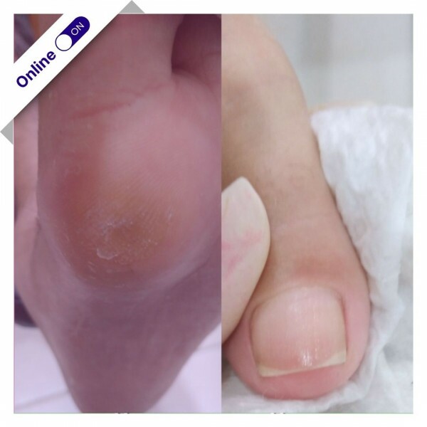 Curso Online - Aprenda a Evitar Unhas Encravadas Curso Online - Aprenda a Evitar Unhas Encravadas