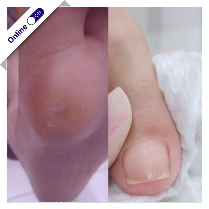 Curso Online - Aprenda a Evitar Unhas Encravadas Curso Online - Aprenda a Evitar Unhas Encravadas