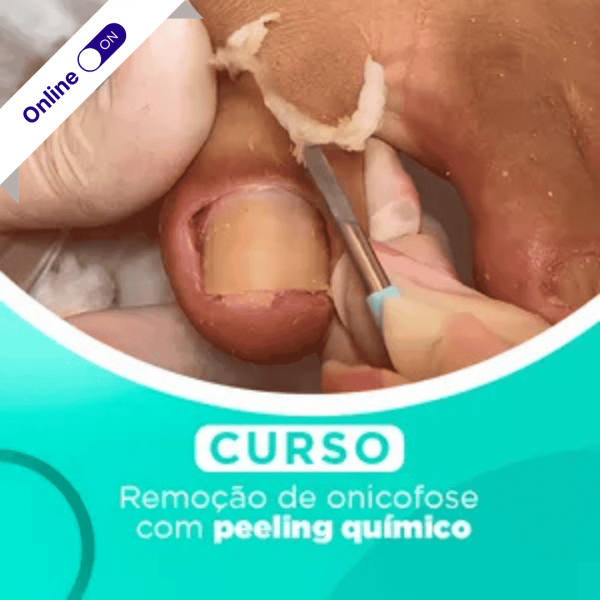 Curso de Podologia online - Remoção de Onicofose com peeling químico