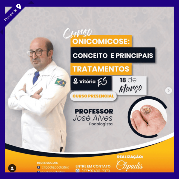 Onicomicose e Tratamentos - José Alves