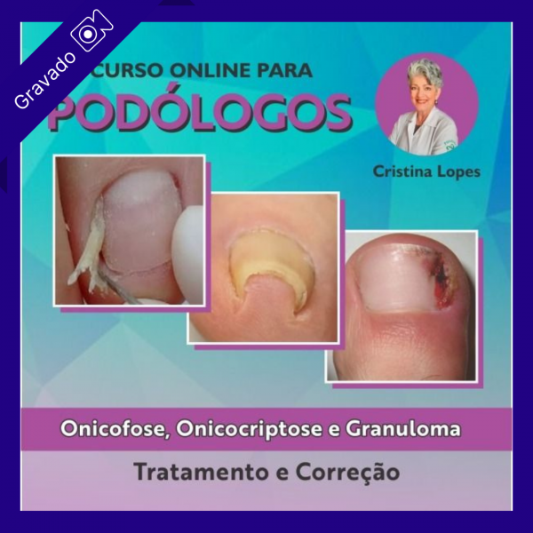 Onicofose, Onicocriptose e Granuloma - Tratamento e Correção - Cristina Lopes