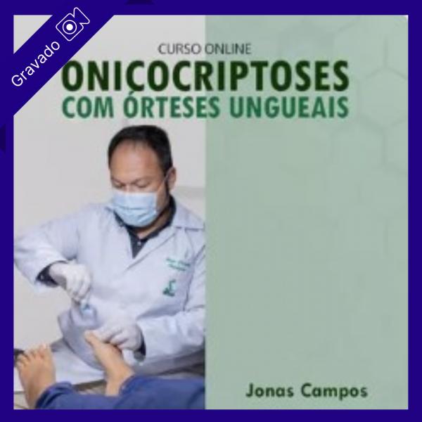 Onicocriptoses com órteses ungueais - Jonas Campos