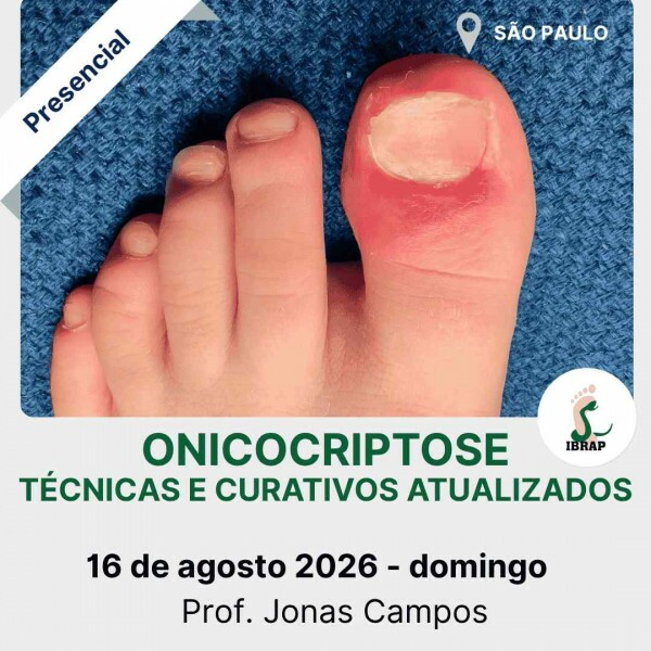 IBRAP - Onicocriptose Técnicas e Curativos Atualizados com Jonas Campos IBRAP - Onicocriptose Técnicas e Curativos Atualizados com Jonas Campos