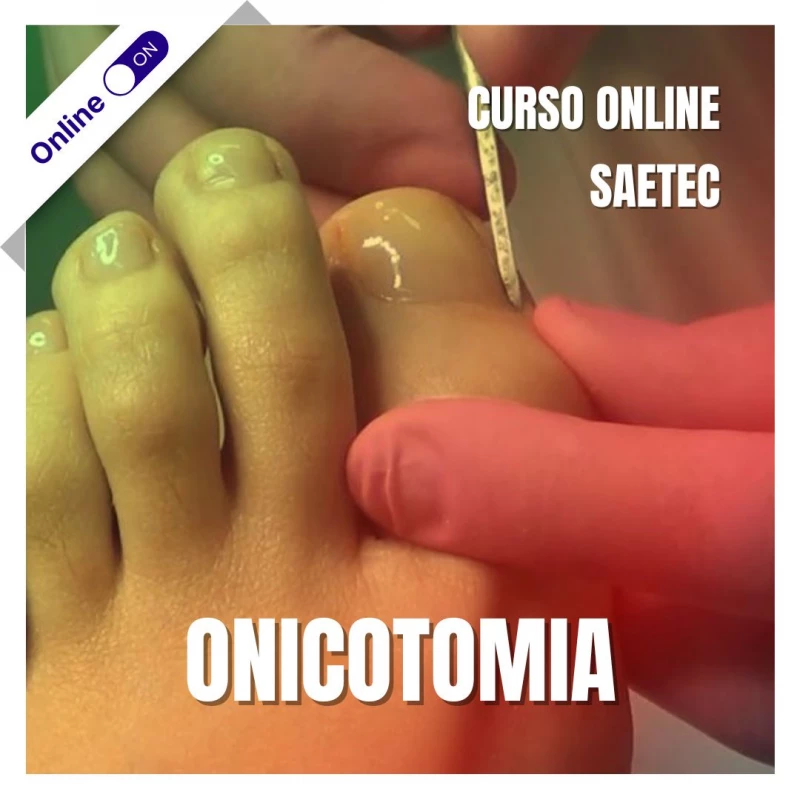 Curso de Podologia Online - Onicotomia
