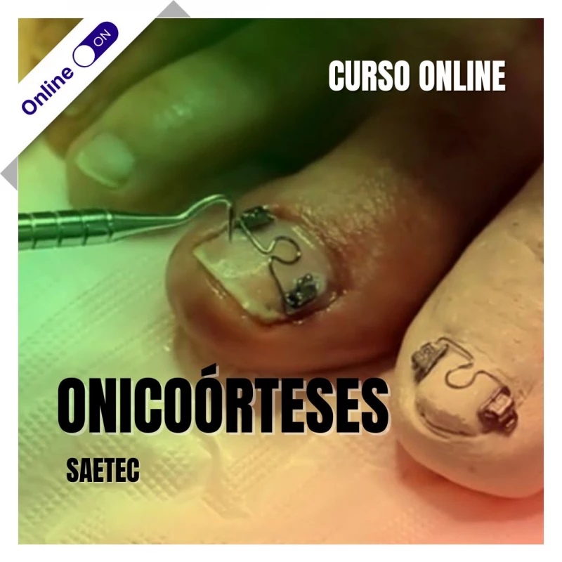 Curso de Podologia Online - Onicoórteses