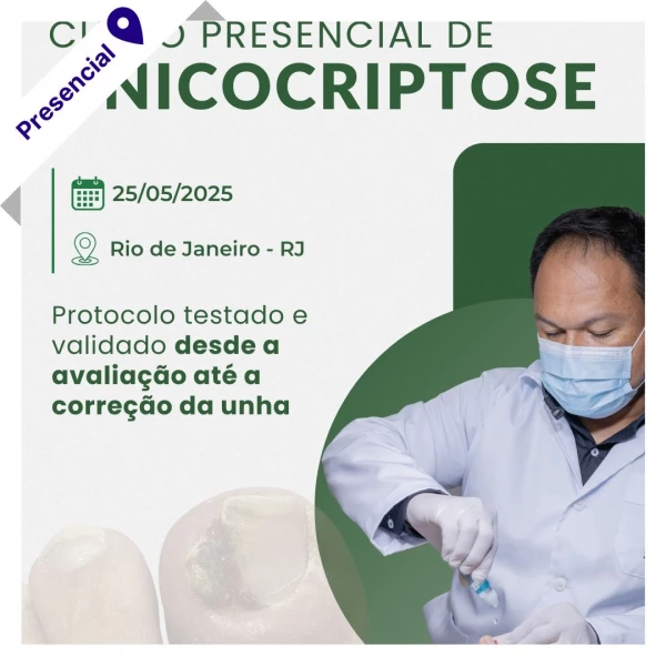 Curso de Podologia Presencial - Onicocriptose com Jonas Campos