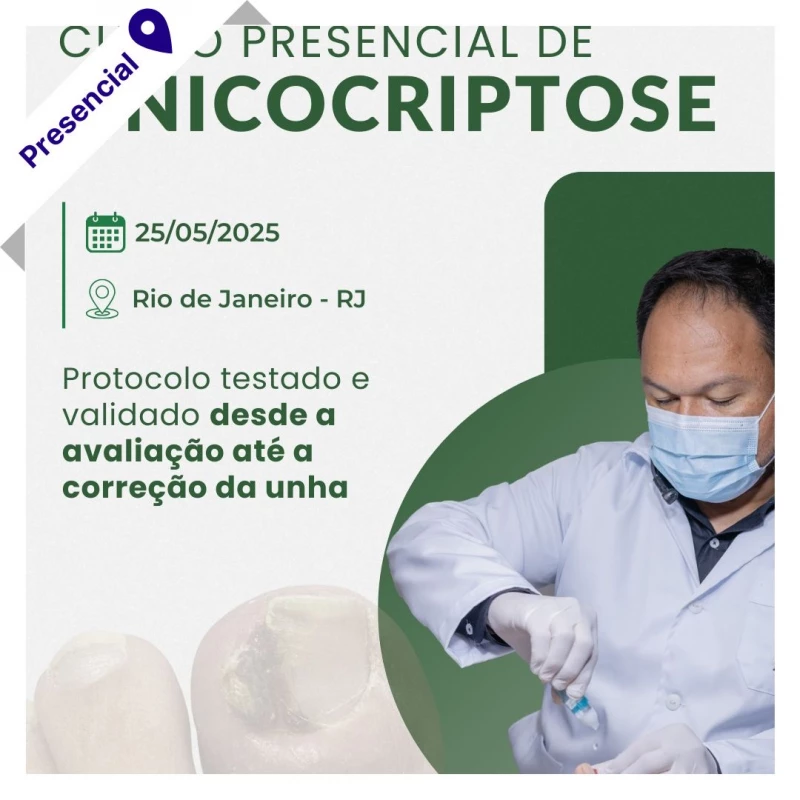 Curso de Podologia Presencial - Onicocriptose com Jonas Campos