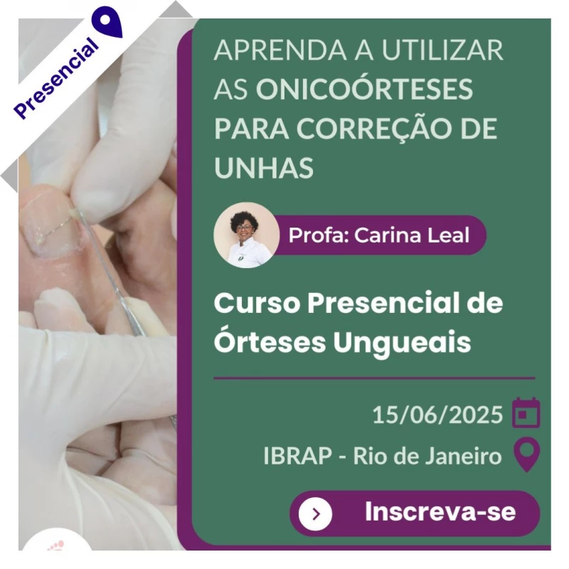 Curso de Podologia Presencial - Órteses Ungueais 